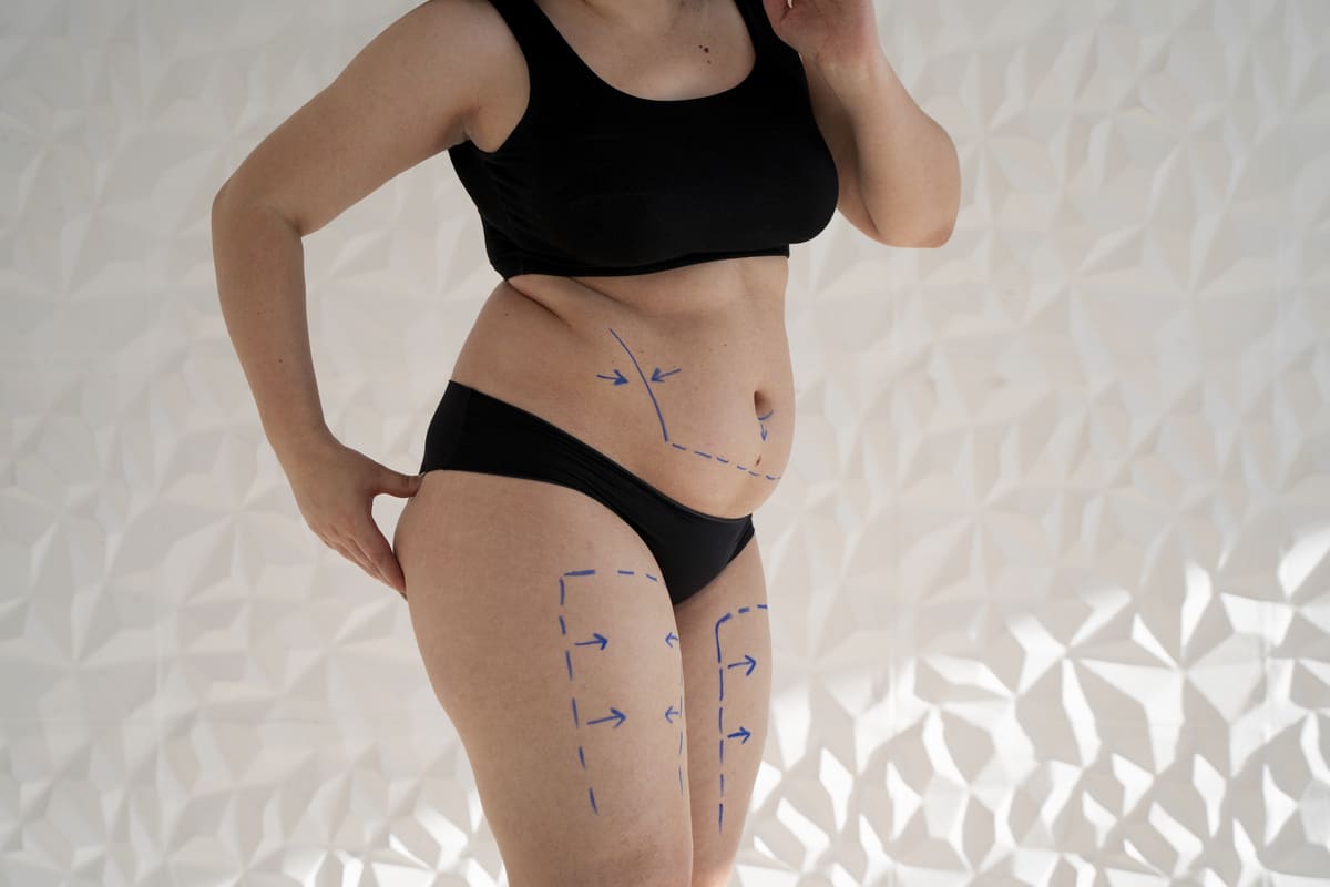 Lipoescultura: o que é e como planejar o procedimento